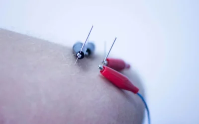 ¿Qué es la electrolisis ecoguiada y cómo acelera la recuperación de tendinopatías deportivas?