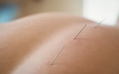 Punción seca guiada por ecografía: tratamiento eficaz para el dolor